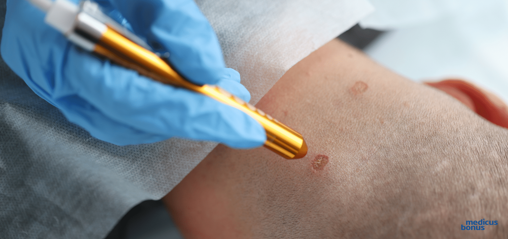 usuwanie pieprzyków